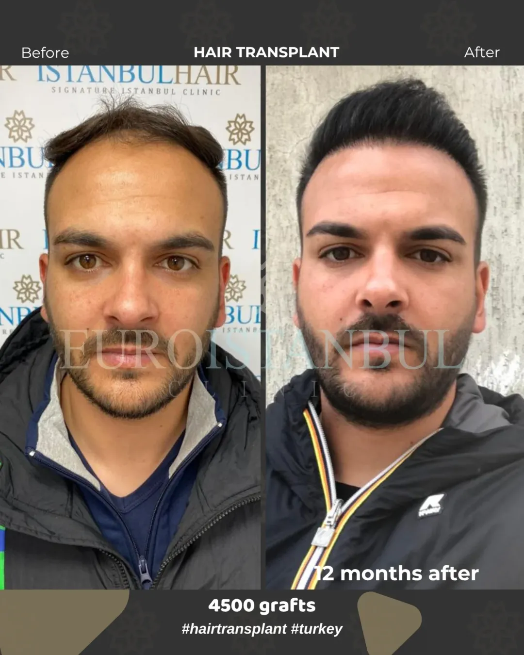 Risultato trapianto capelli prima e dopo 12 mesi