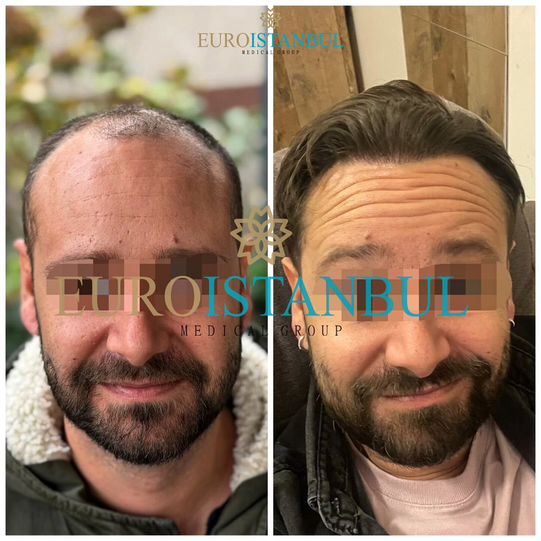 Risultato trapianto capelli tecnica DHI a 12 mesi