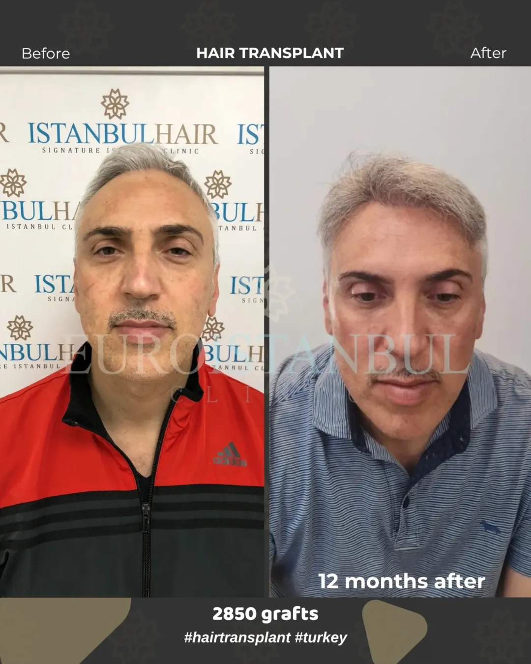 Risultato trapianto capelli prima e dopo 12 mesi