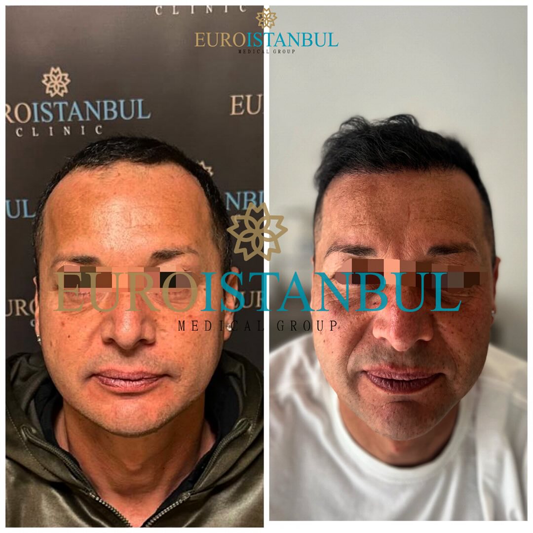 Risultato trapianto capelli prima e dopo 5 mesi